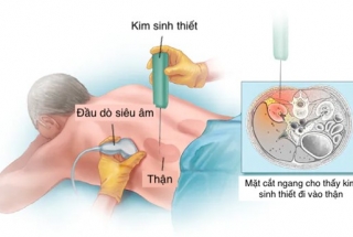 CÁC PHƯƠNG PHÁP SINH THIẾT VÀ XÉT NGHIỆM TẾ BÀO HỌC ĐỂ PHÁT HIỆN UNG THƯ